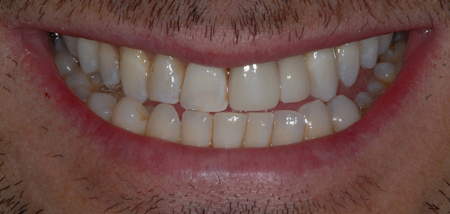 After photo for bridges